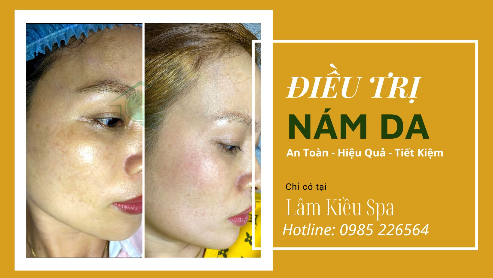 Dịch vụ ĐIỀU TRỊ NÁM
